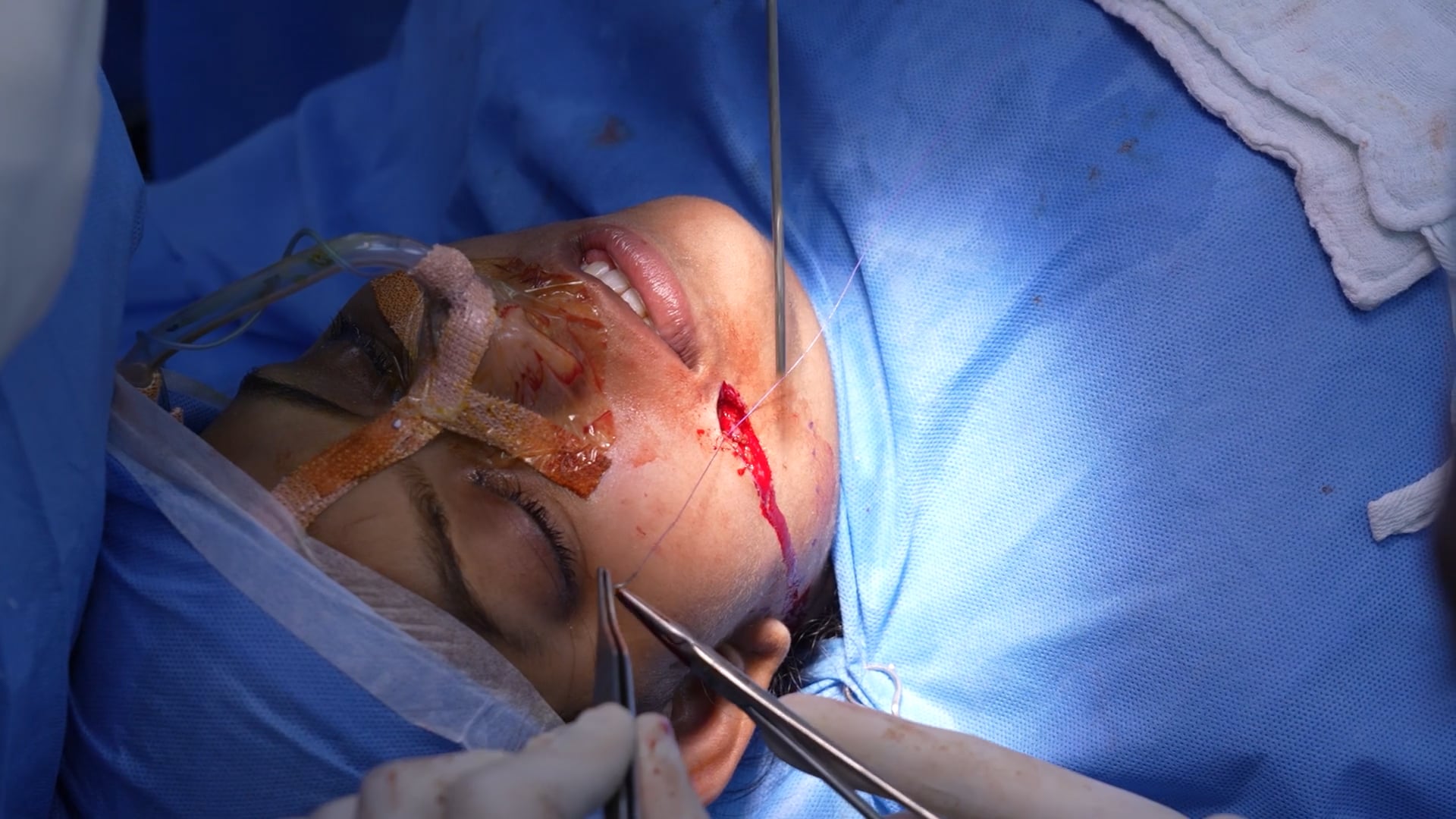 Scar Revision for a girl